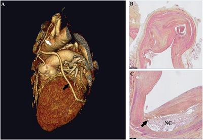 Inflammation in Vein Graft Disease